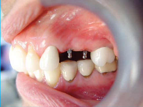 Dental Implants from Celeb Jaws Health